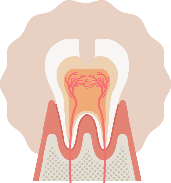 C1から進行した状態
