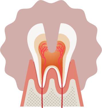 C2より進行した深い虫歯