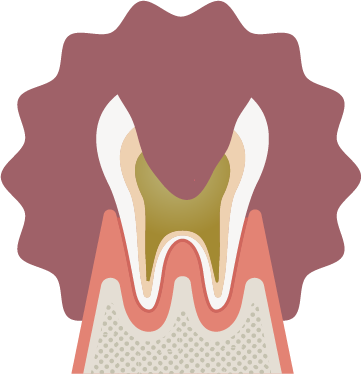 末期の虫歯