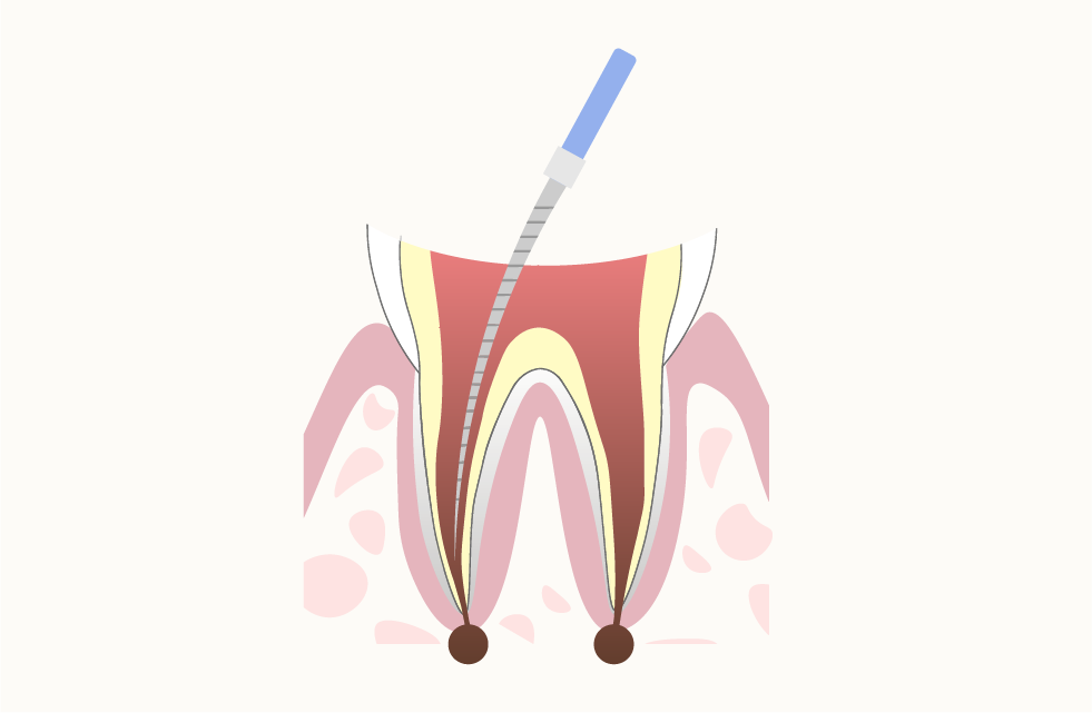 根管治療について