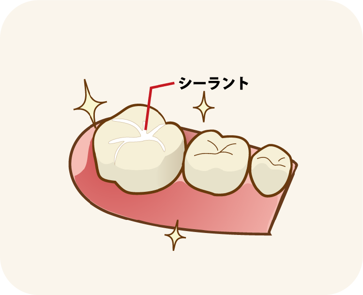 シーラントによる予防