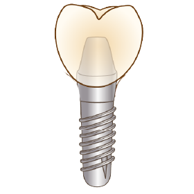 インプラント