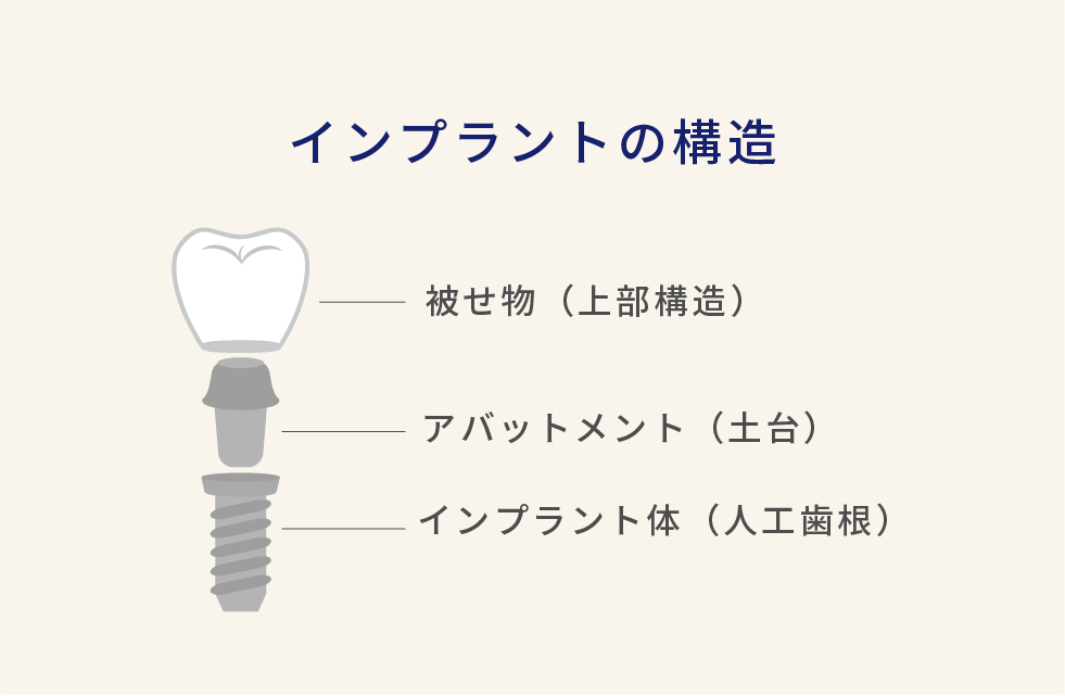 インプラントの構造