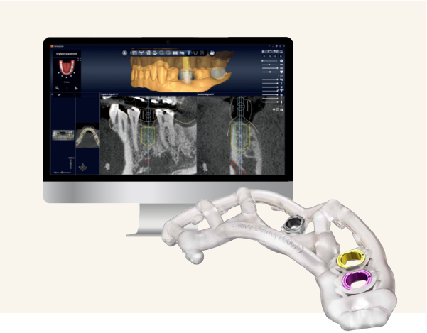 サージカルガイド作製