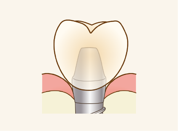 被せ物製作・装着