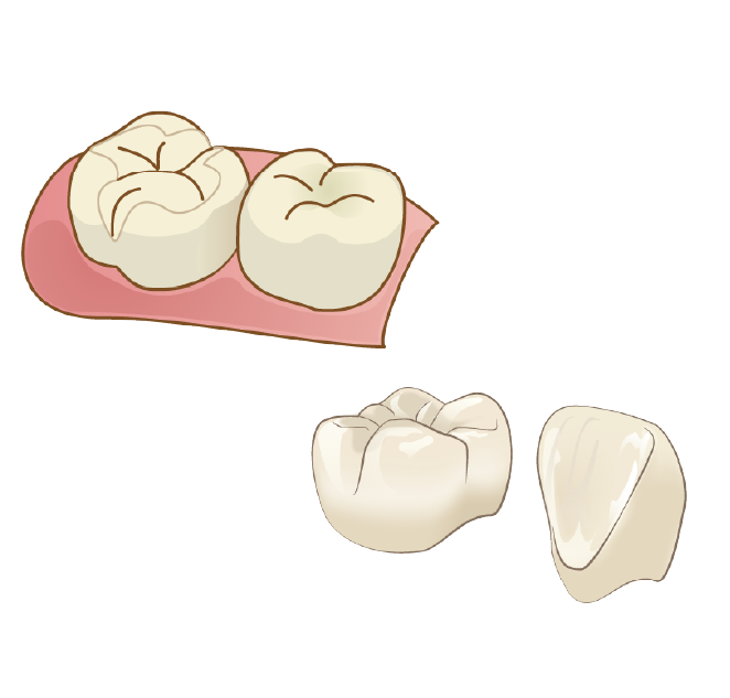 emaxインレー/クラウン