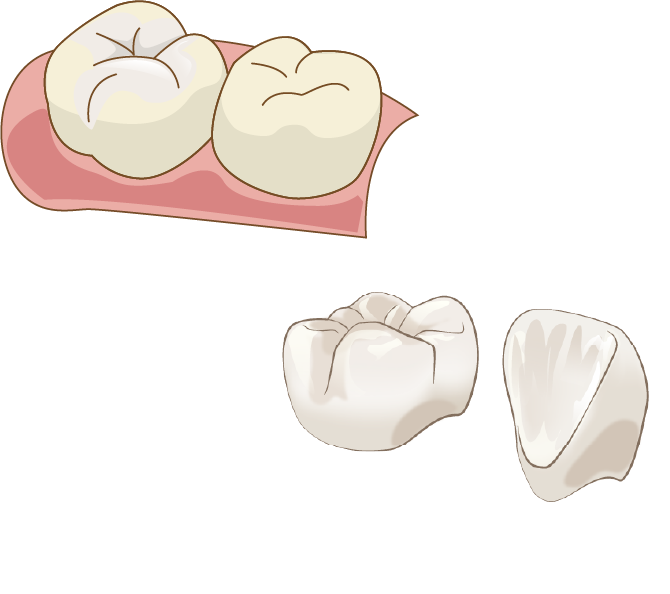 ジルコニアインレー/ジルコニアクラウン