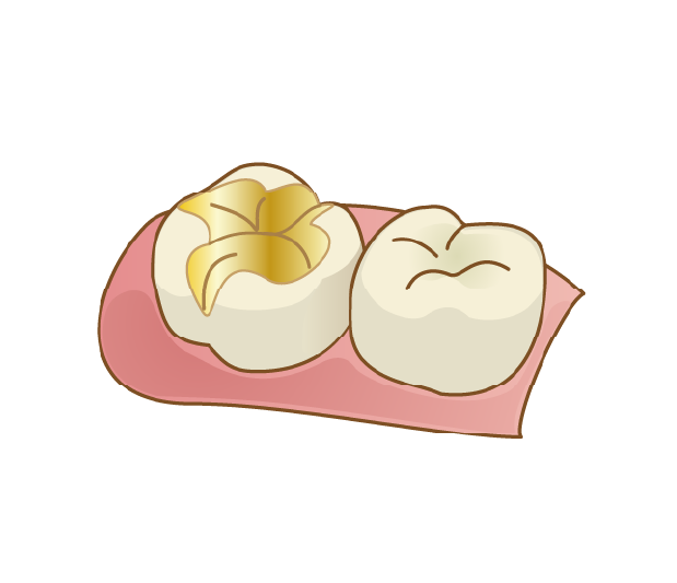 ゴールドインレー