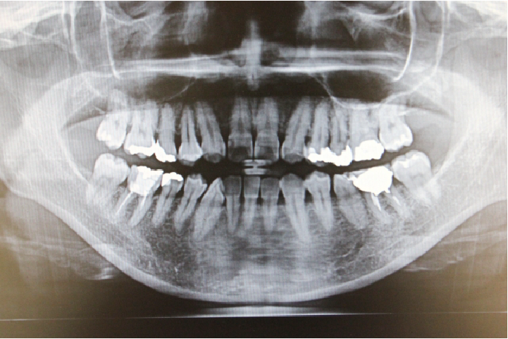 レントゲン検査