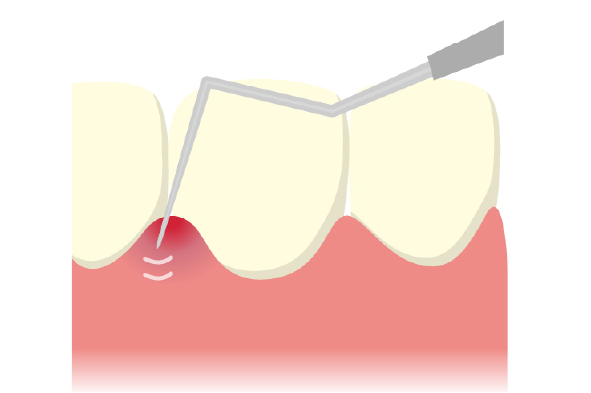 歯周ポケットの深さ