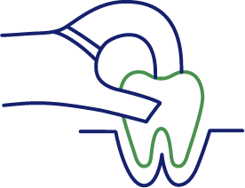 親知らず(埋伏歯)