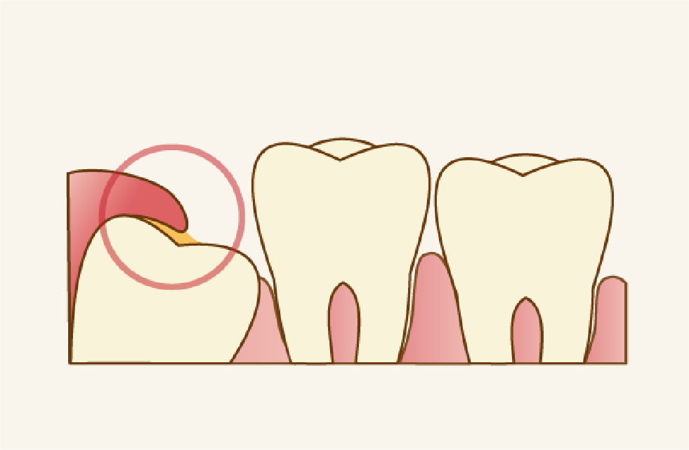 虫歯や歯周病のリスク